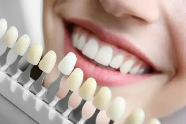 laser whitening Faqs Kempston